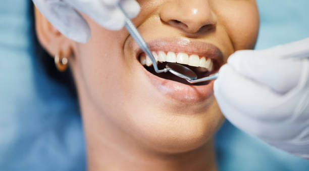 Best Chipped Tooth Repair Near Me  in Solon, OH